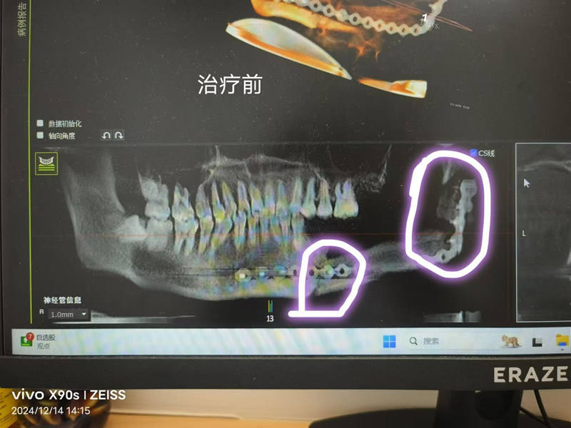 图1 治疗前.jpg