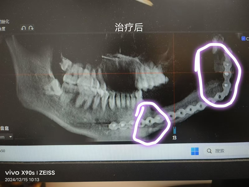 图2 治疗后.jpg